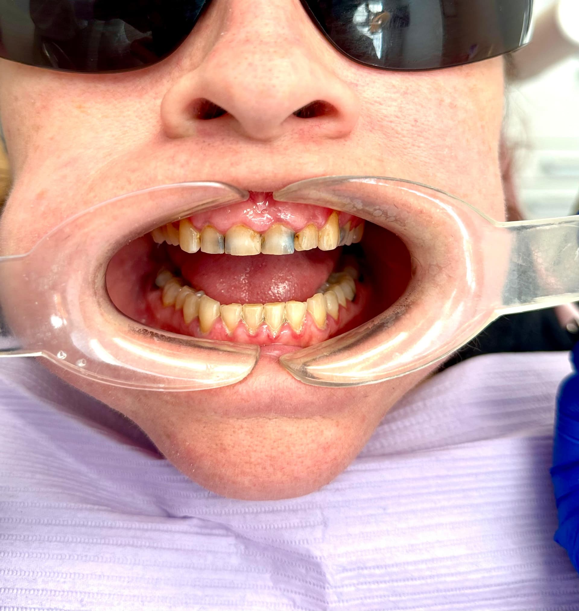 Patient 2 before treatment