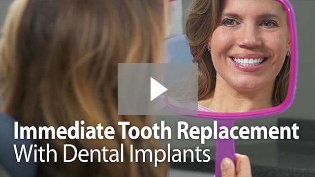 Immediate Tooth Replacement