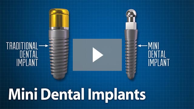 Mini Dental Implants