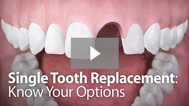 Single Tooth Replacement