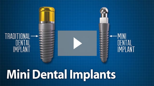 Mini Dental Implants