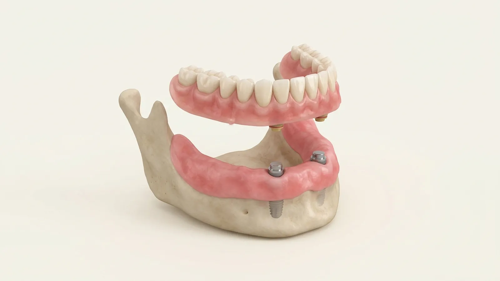 Illustration: a lower denture with two snap-in housings, shown above two implants with low-profile attachments in the front of the lower jaw.