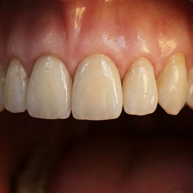Replacing a Missing Front Tooth: The Art and Science of a Perfect Implant