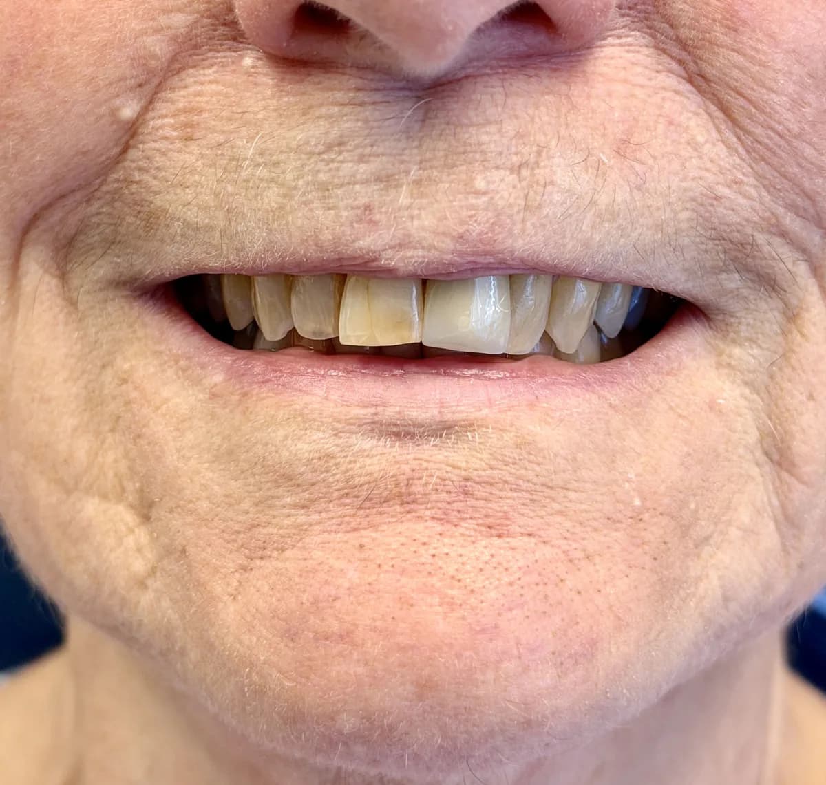 Linda B after two porcelain crowns on her upper front teeth (restored, natural-looking smile)