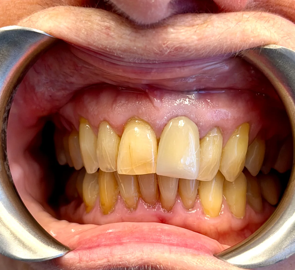 Linda B before two porcelain crowns on her upper front teeth at Innova Smiles in Marlborough, MA — visible wear and discoloration on the central incisors