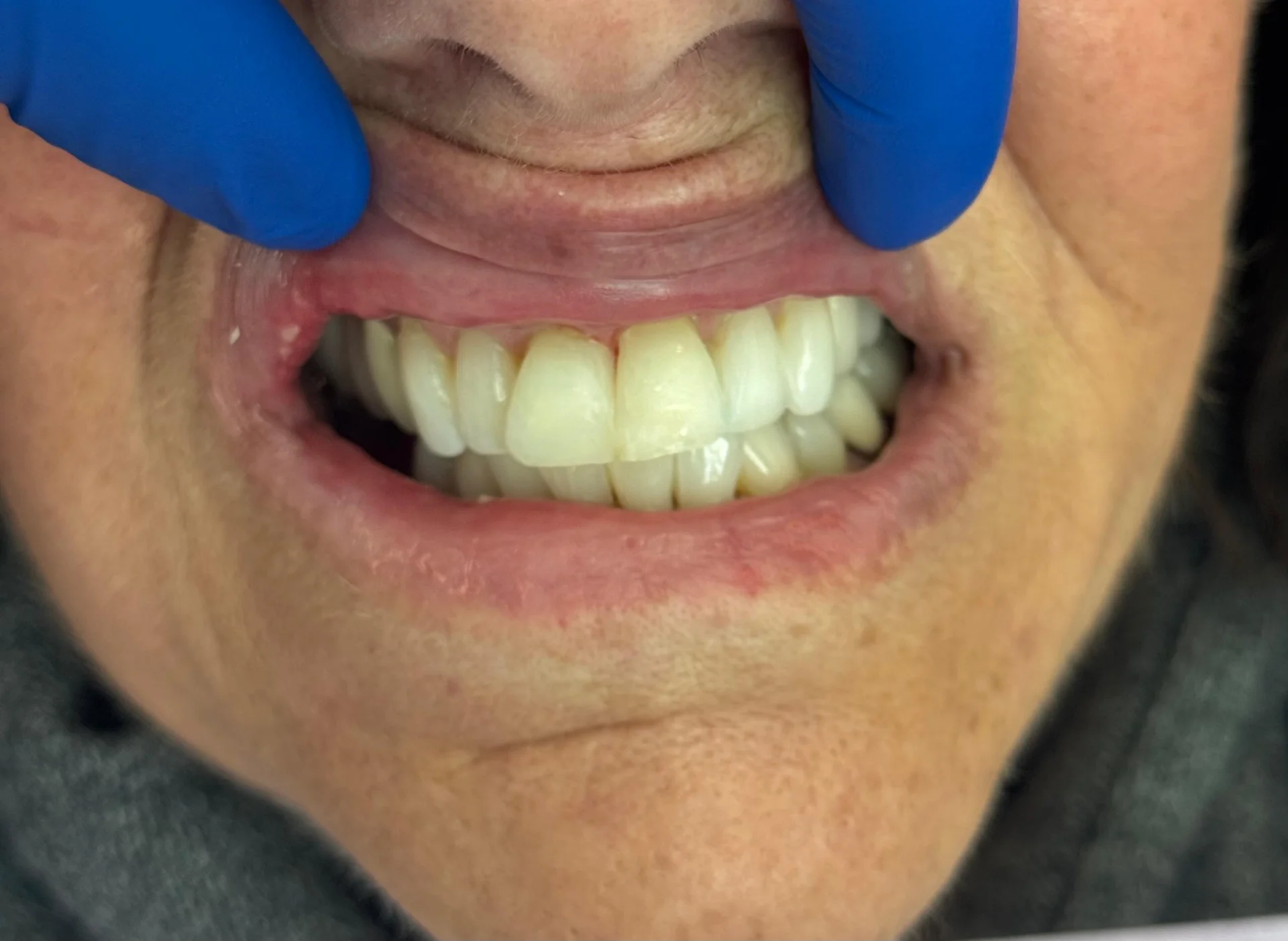 Patient 3 after composite resin bonding with the gap closed and seamless smile