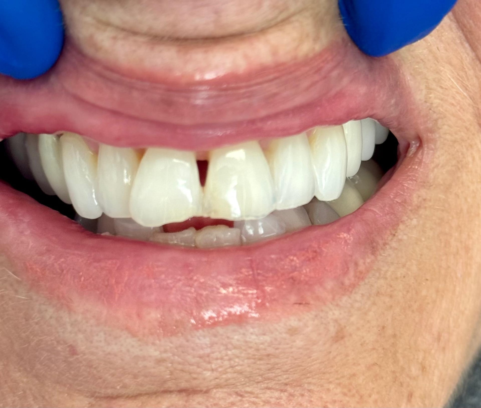 Patient 3 before treatment with black triangle between upper front teeth