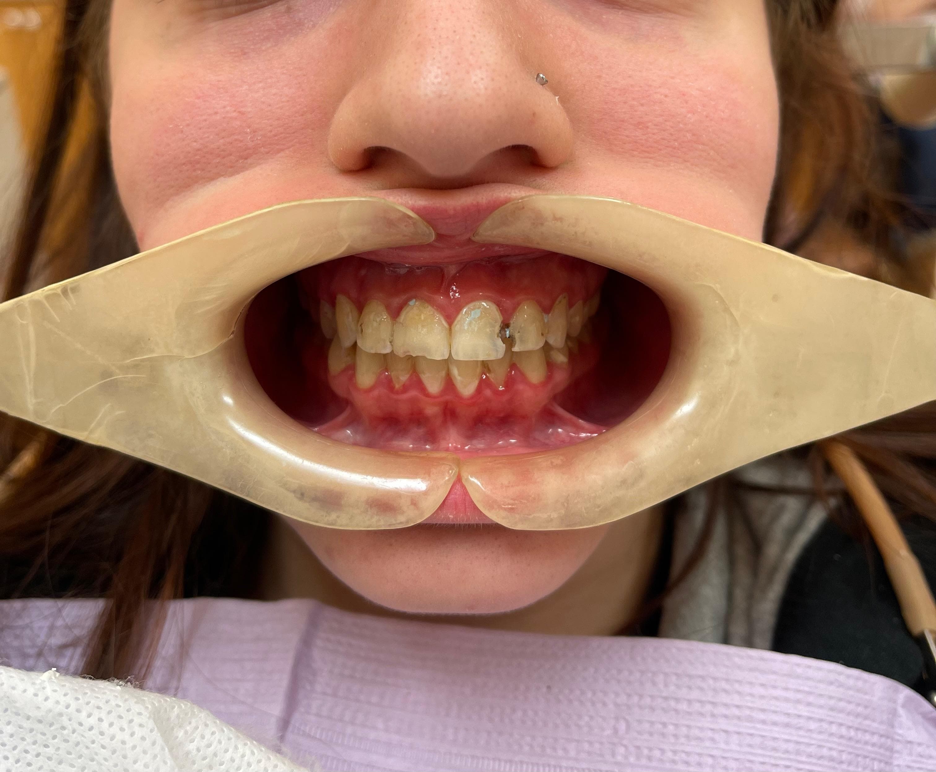 Patient 1 before treatment with extensive tooth decay and visible anxiety