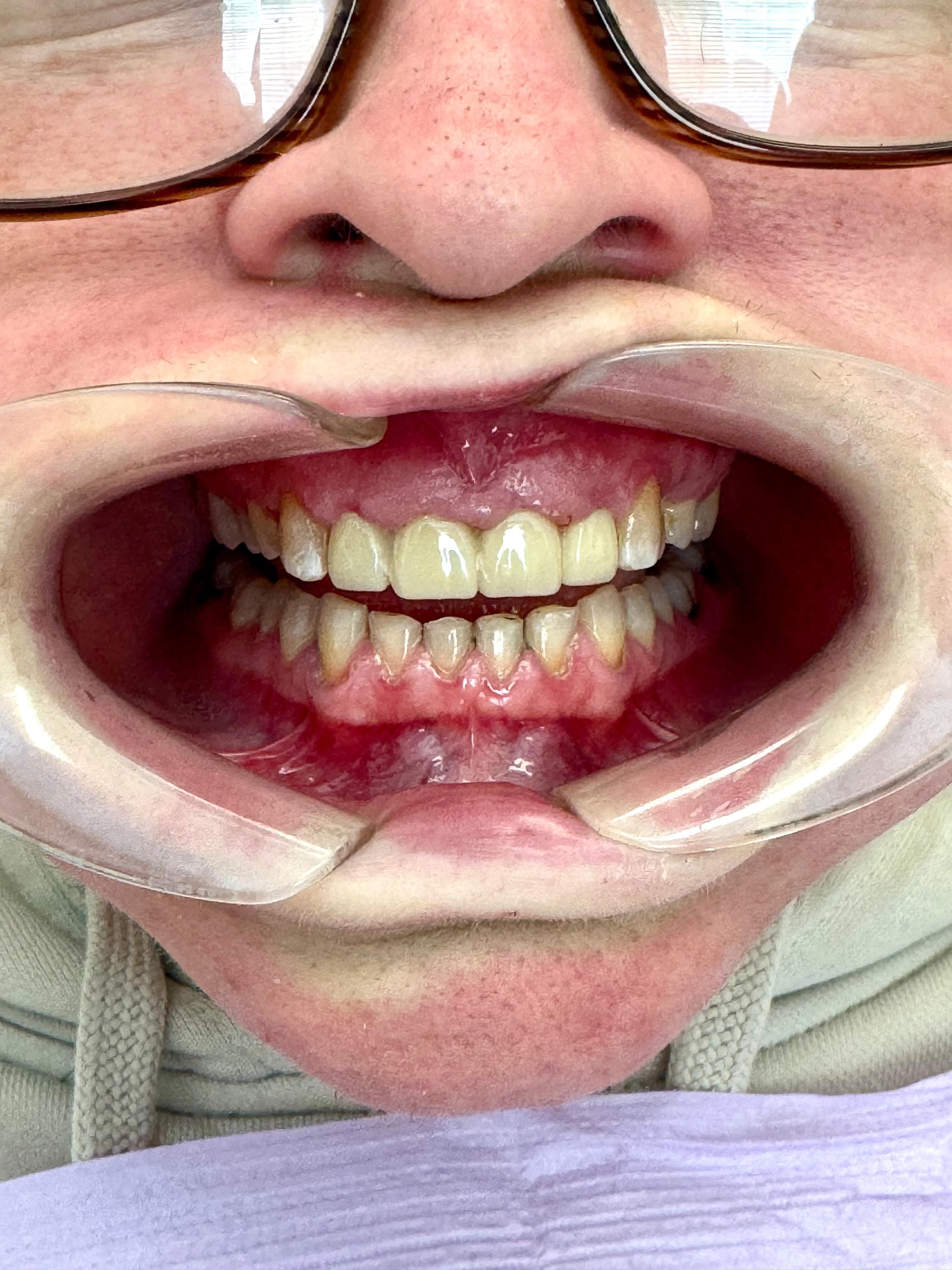 Patient 2 after crowns placed on upper front teeth with restored esthetics