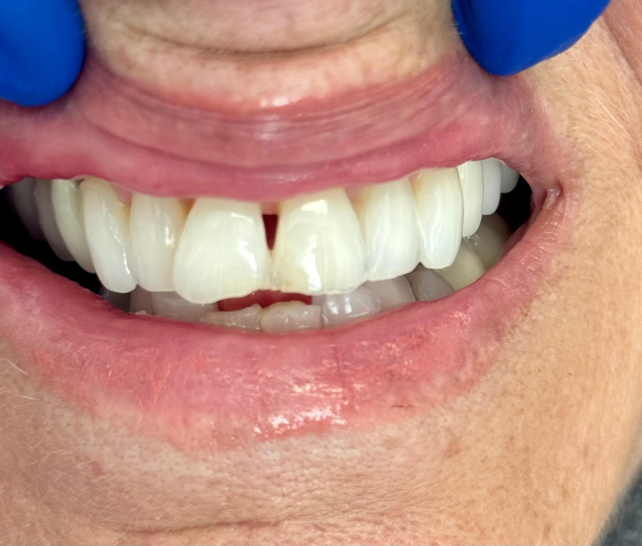 Patient 3 before treatment with black triangle between upper front teeth