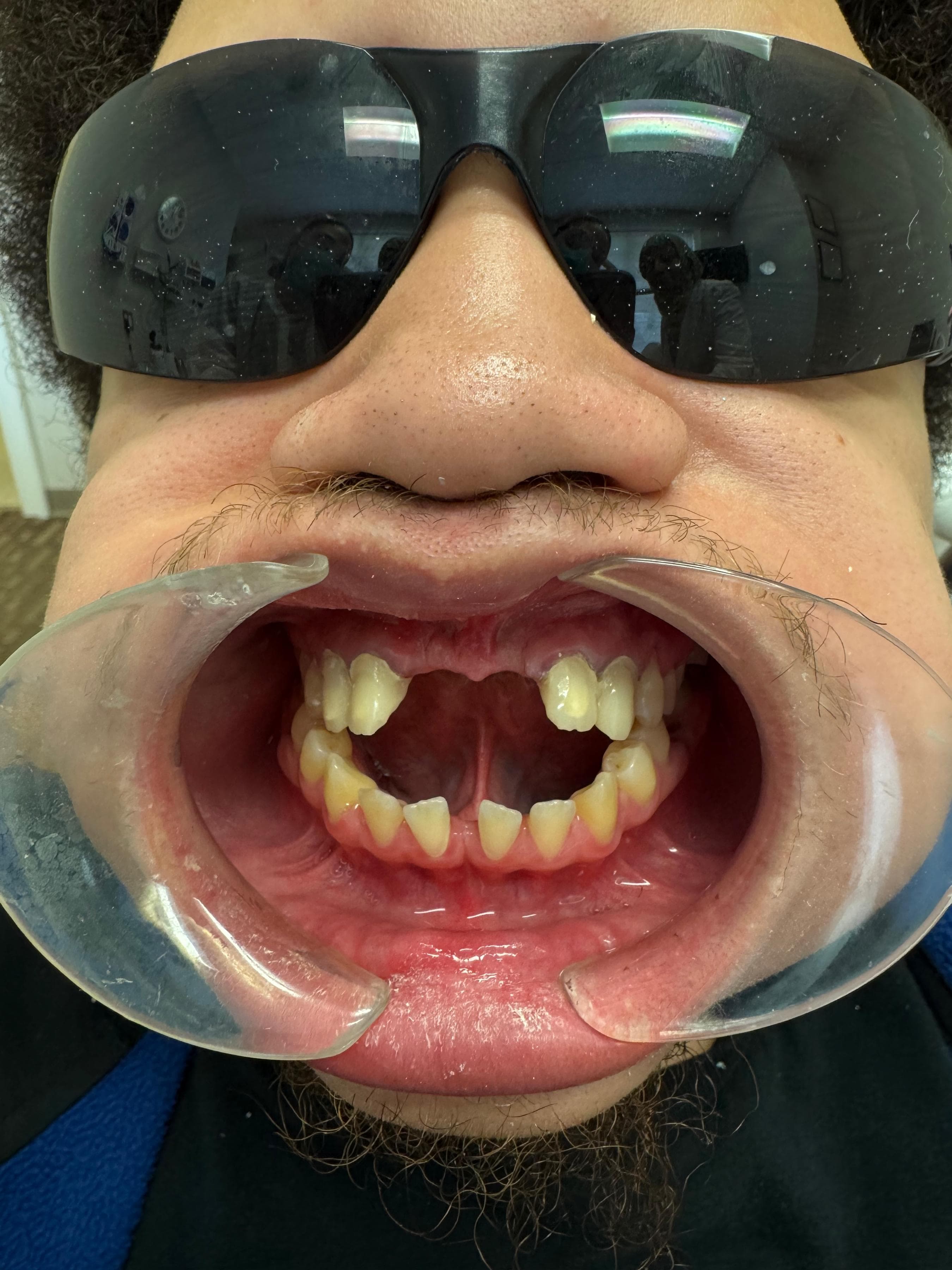 Patient 4 before treatment (traumatic upper front tooth loss)