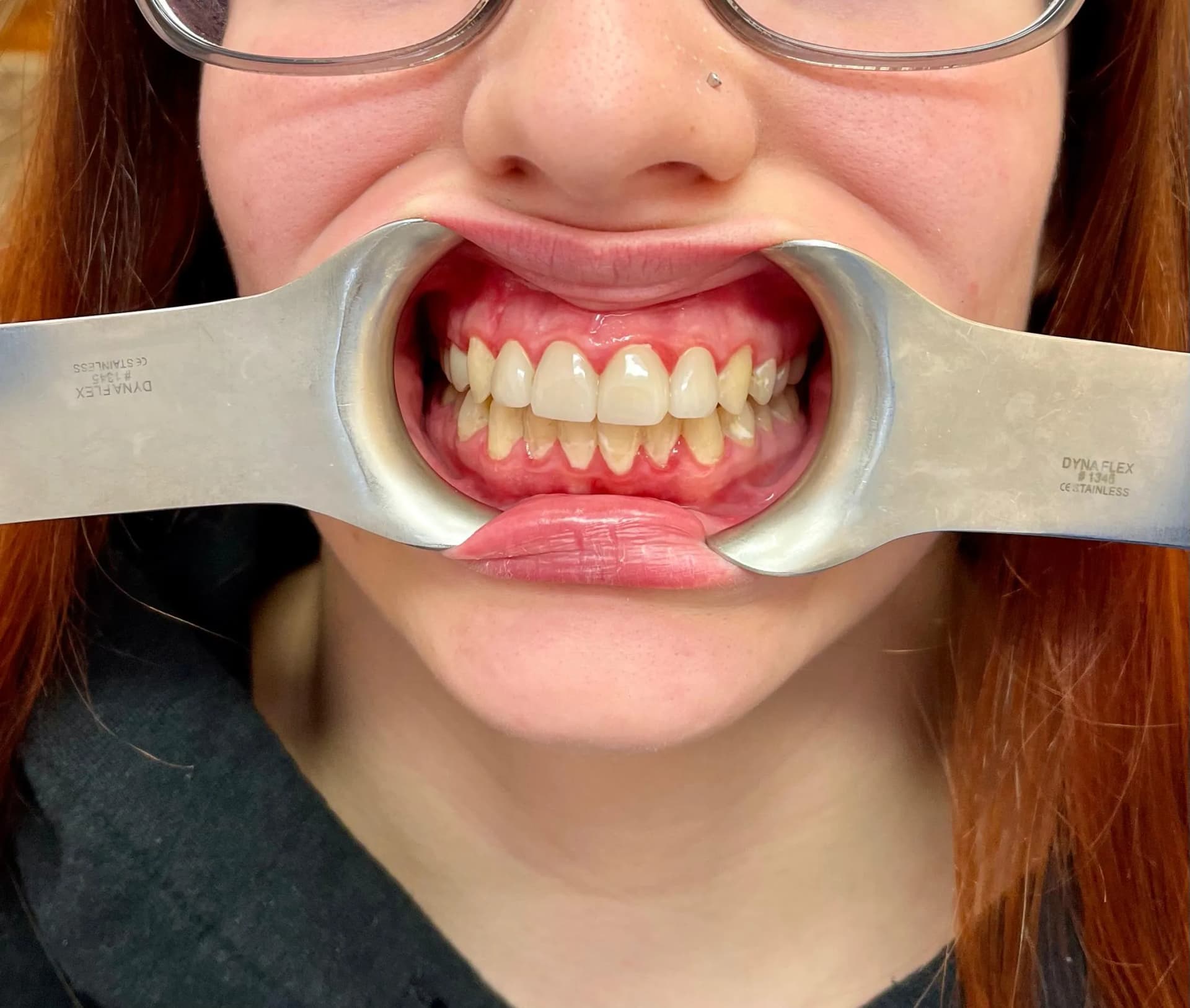 Patient 1 after composite restorations, with a cleaner, healthier smile