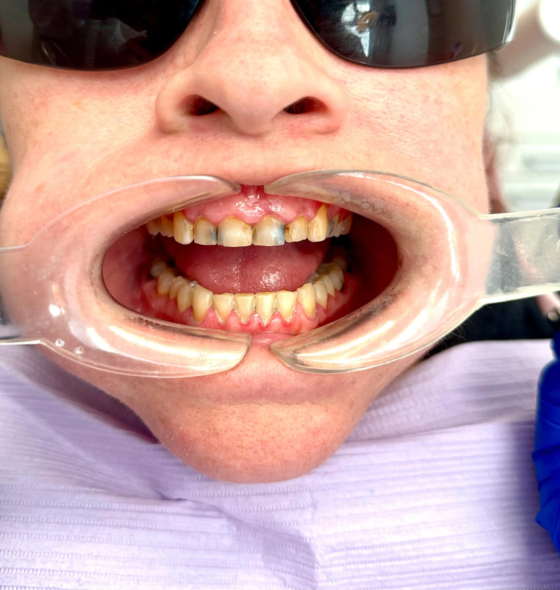 Patient 2 before crown treatment for worn and discolored front teeth