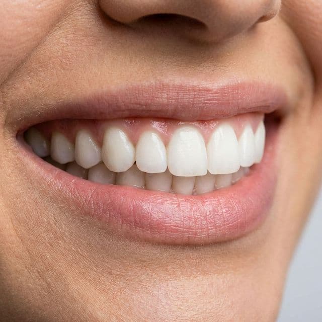 Invisalign crowding correction result at Innova Smiles in Marlborough, MA