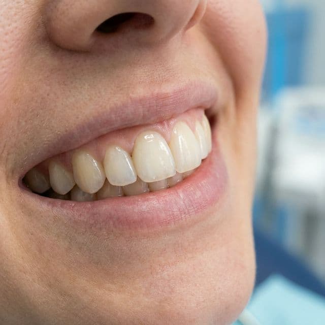 Close up of a dental bonding repair